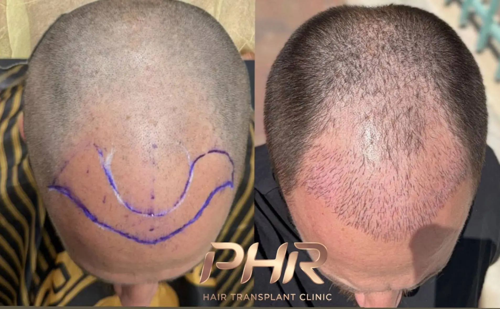 PHR Clinic – לפני ואחרי השתלת שיער · 7 ימים