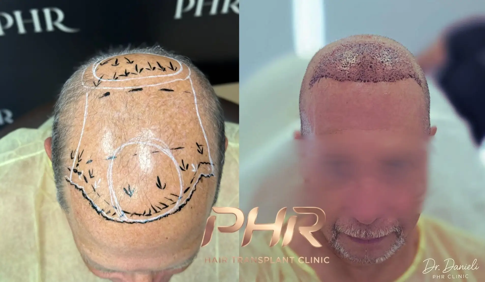 PHR Clinic – לפני ואחרי השתלת שיער FUE בישראל