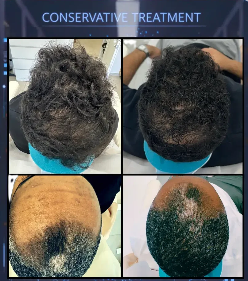 Donor Zone Preservation – מבט Holo Grid על שימור אזור תורם