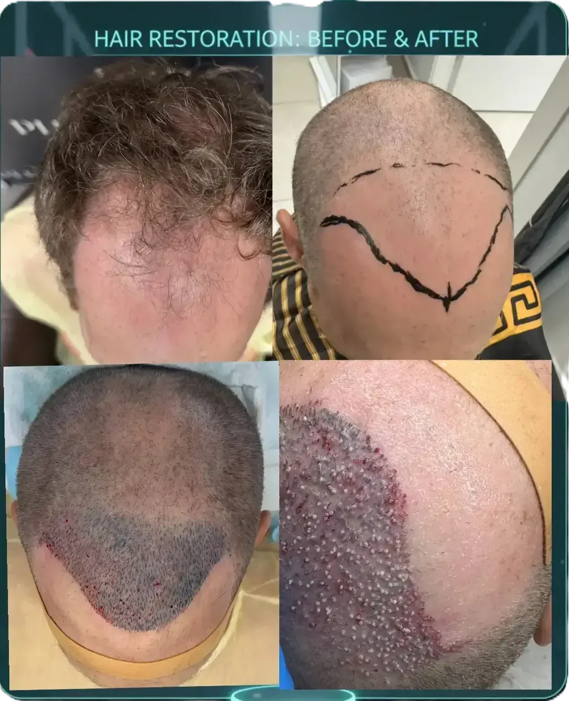 Full Pattern Correction – סקירת ארכיטקטורת זקיקים מלאה ב-PHR Clinic