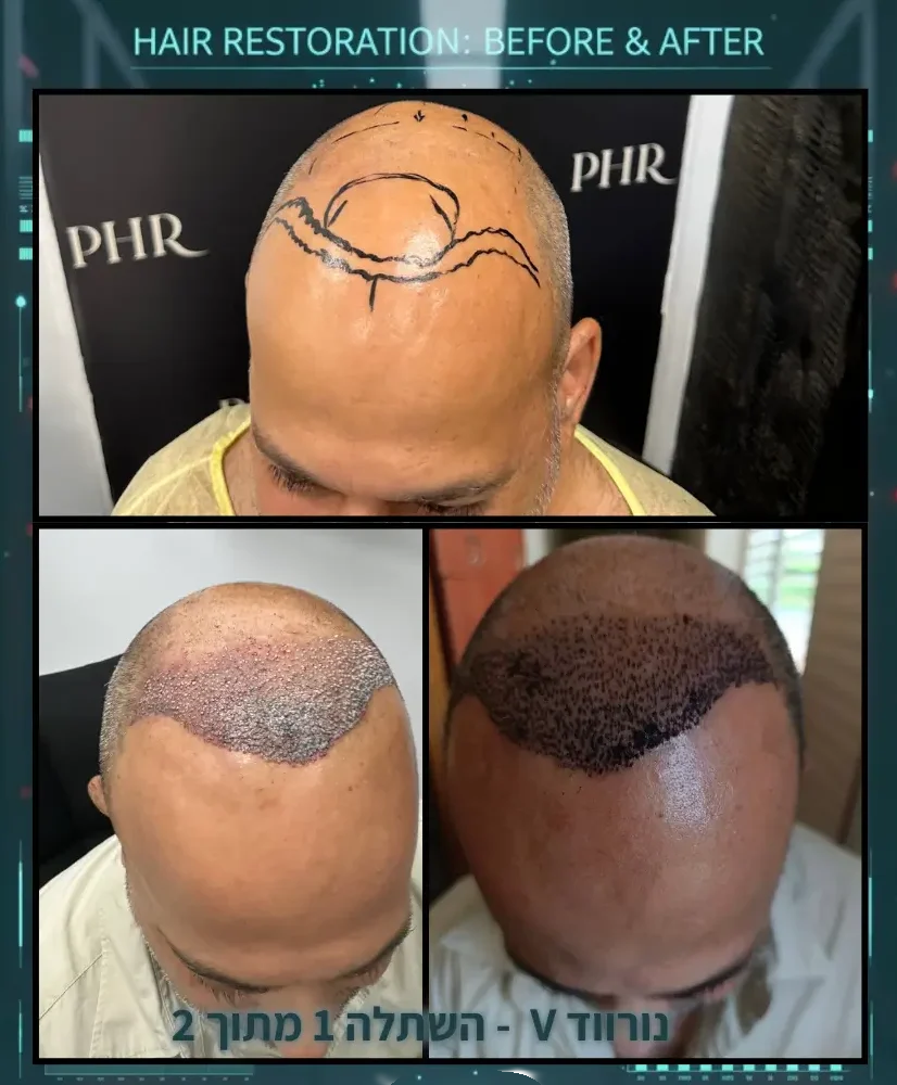 Crown Reconstruction – שחזור קודקוד ומטריקס לאחר ניתוח