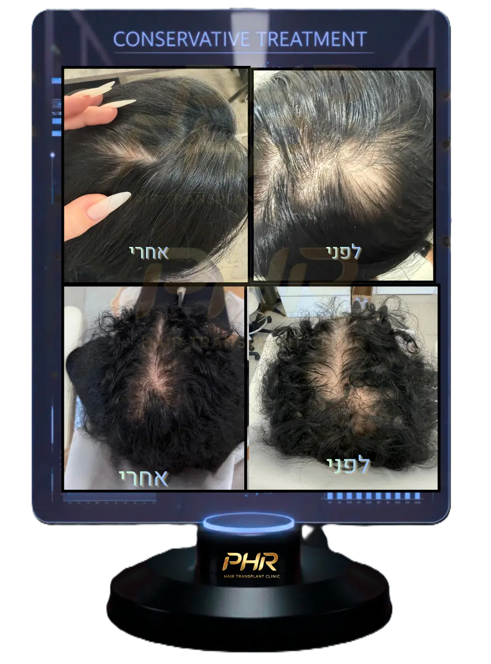 טיפול שמרני לדילול מפושט — מיפוי ותכנון טיפול