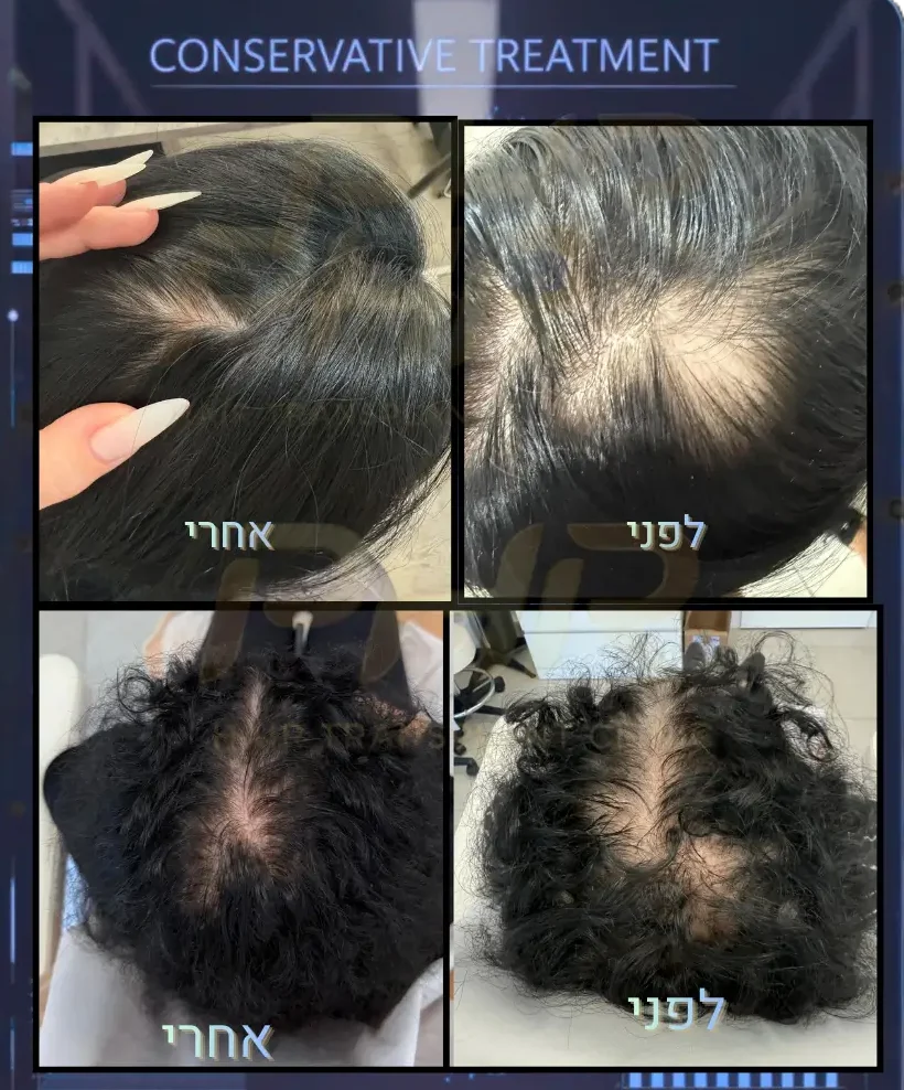 Diffuse Thinning Control – מפה טיפולית לדלילות דיפוזית