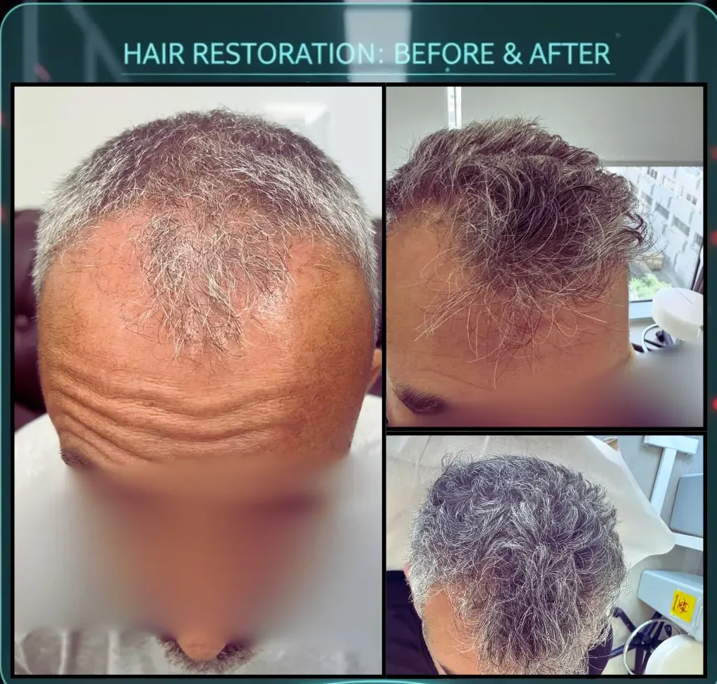 Frontline Density Recovery – סקירה קלינית של שיקום קו קדמי