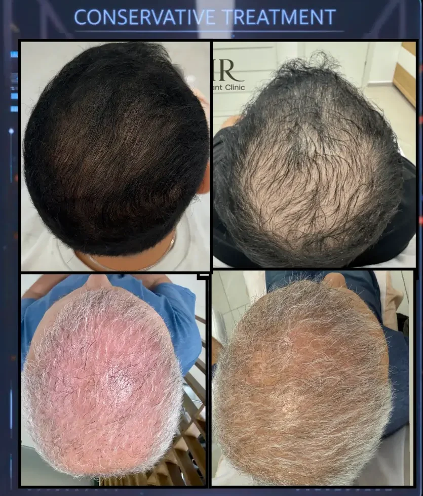 Global Density Enhancement – השוואת צפיפות גלובלית לפני/אחרי