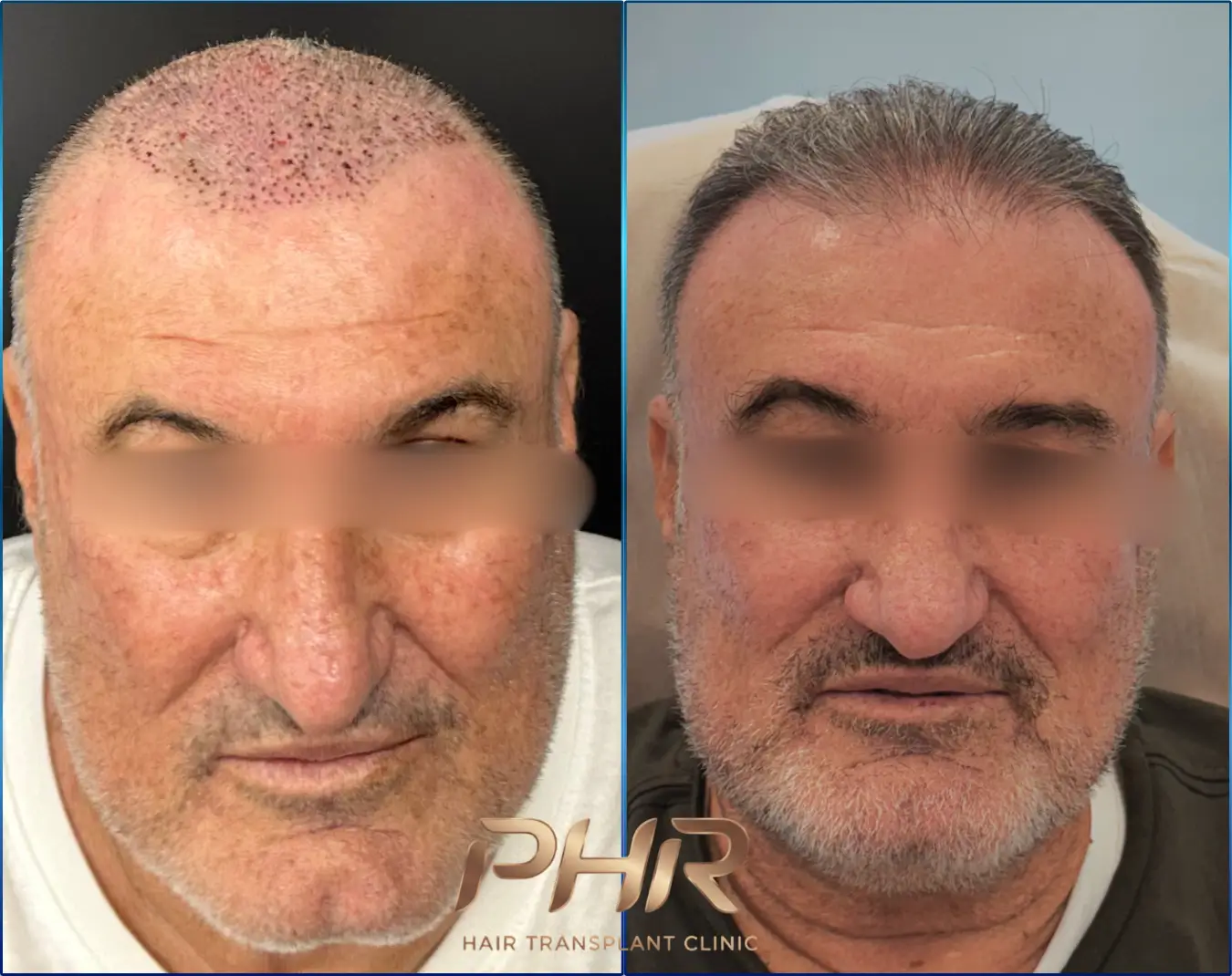 PHR Clinic – לפני ואחרי השתלת שיער · 90 ימים