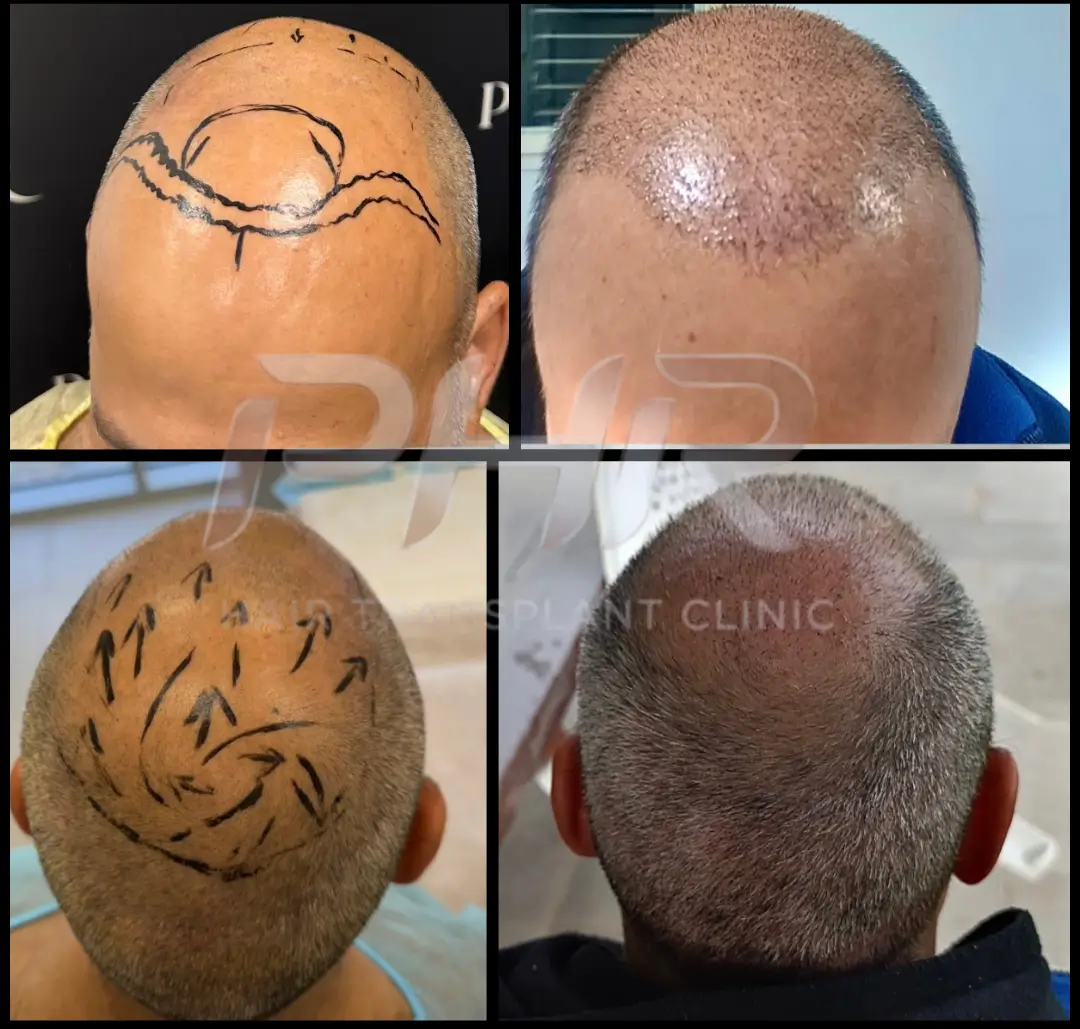 שחזור מתקדם &ndash; 7 ימים לאחר ההשתלה