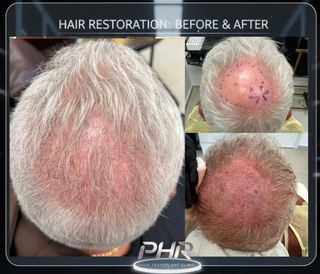 שחזור קודקוד &ndash; 6 חודשים אחרי