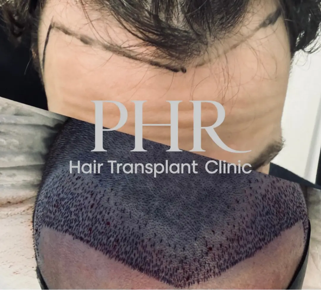 קו שיער אנטומי למטופל צעיר