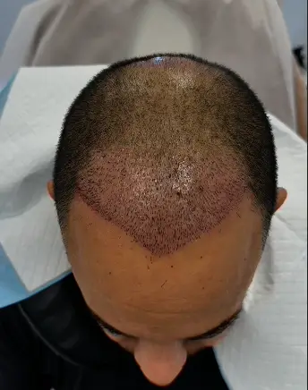 10 ימים לאחר ההשתלה