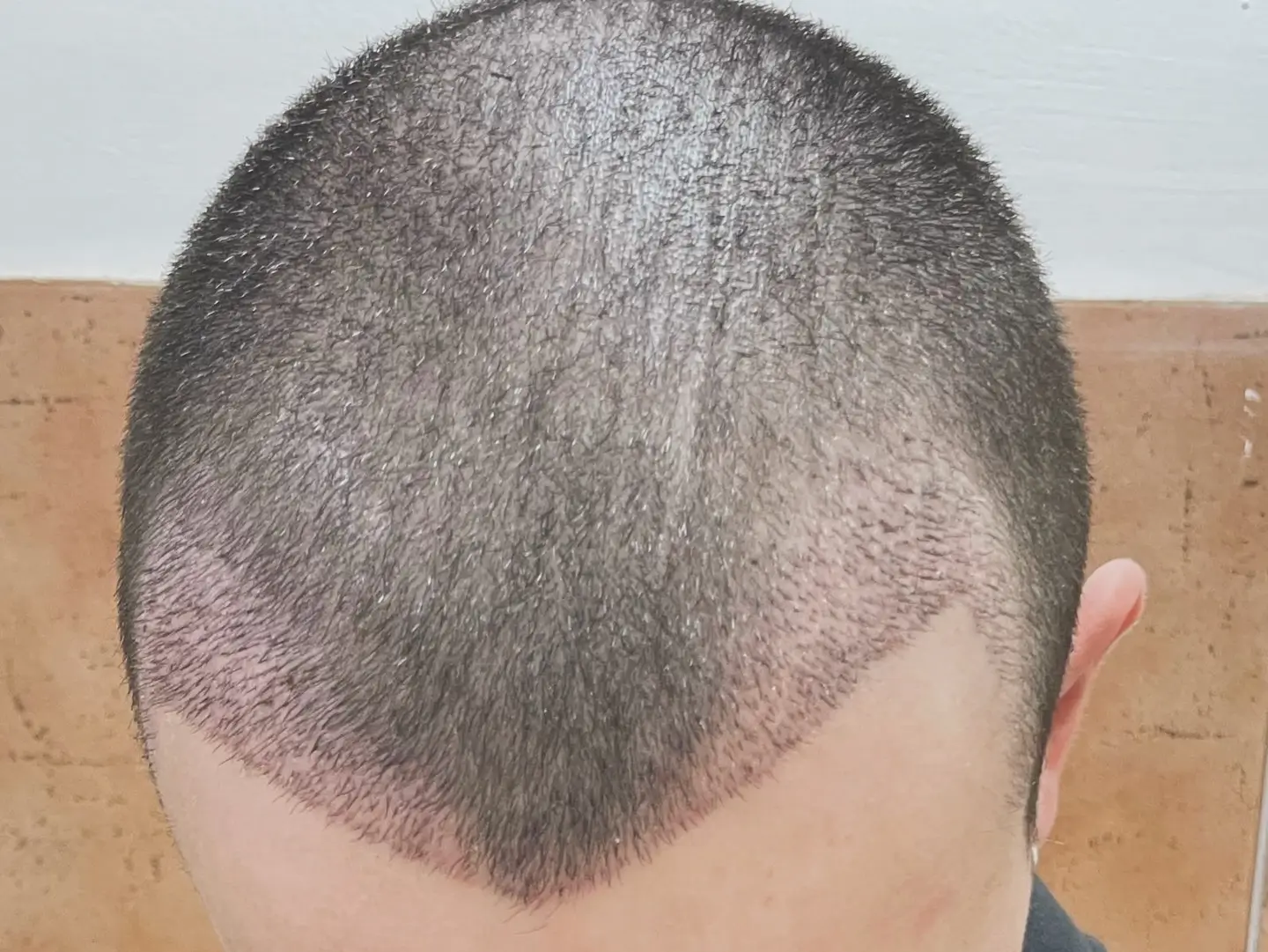 ניתוח השתלת שיער FUE