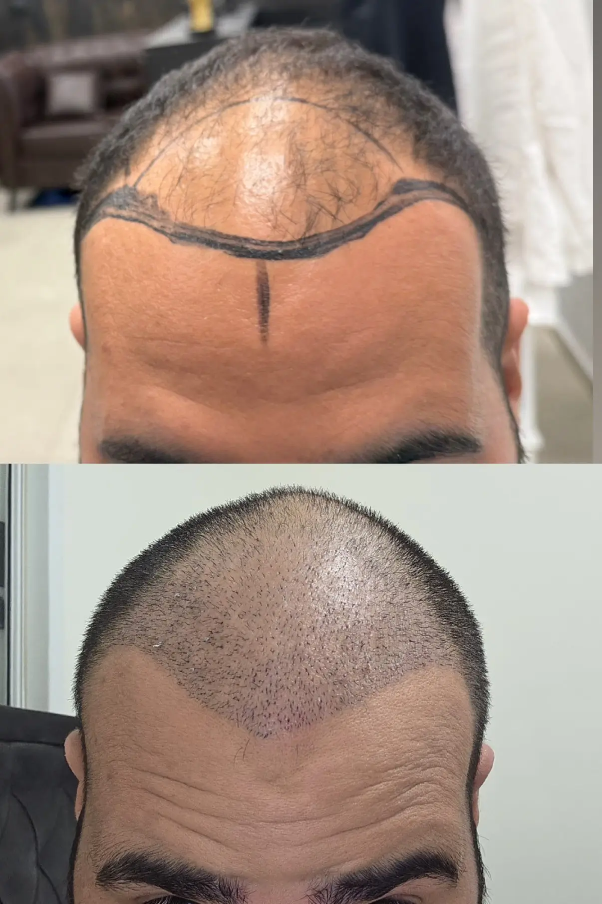 FUE &mdash; לפני ואחרי