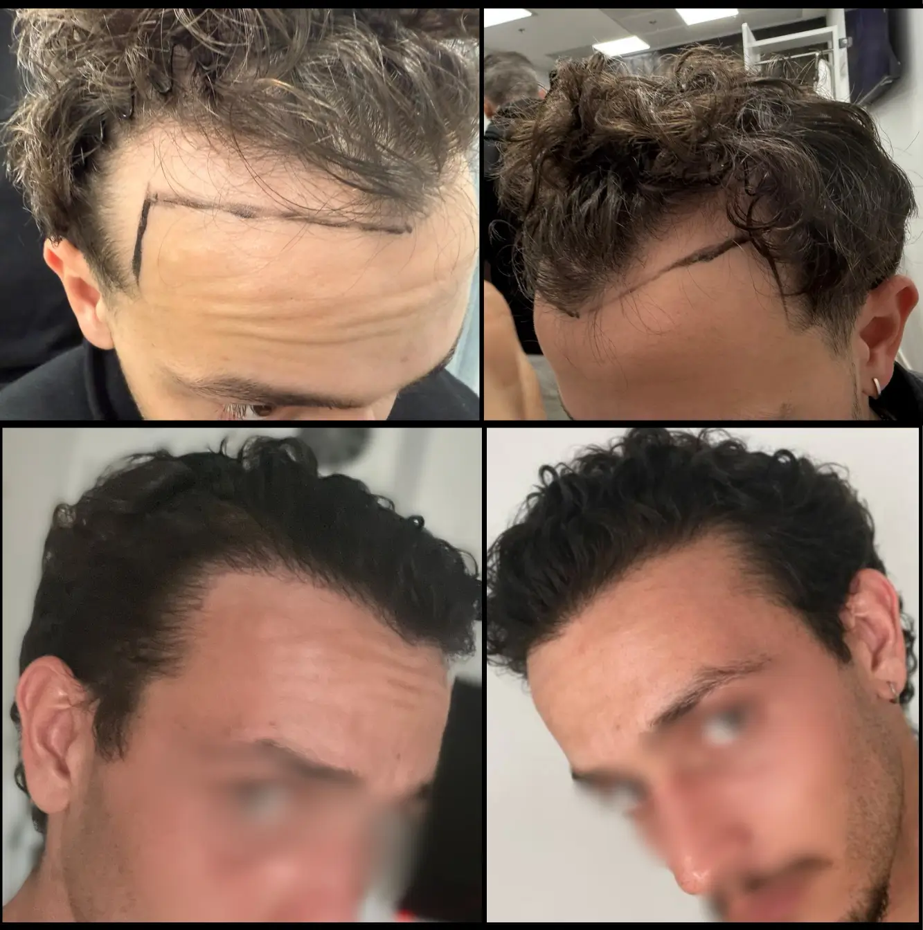 שחזור קו שיער קדמי