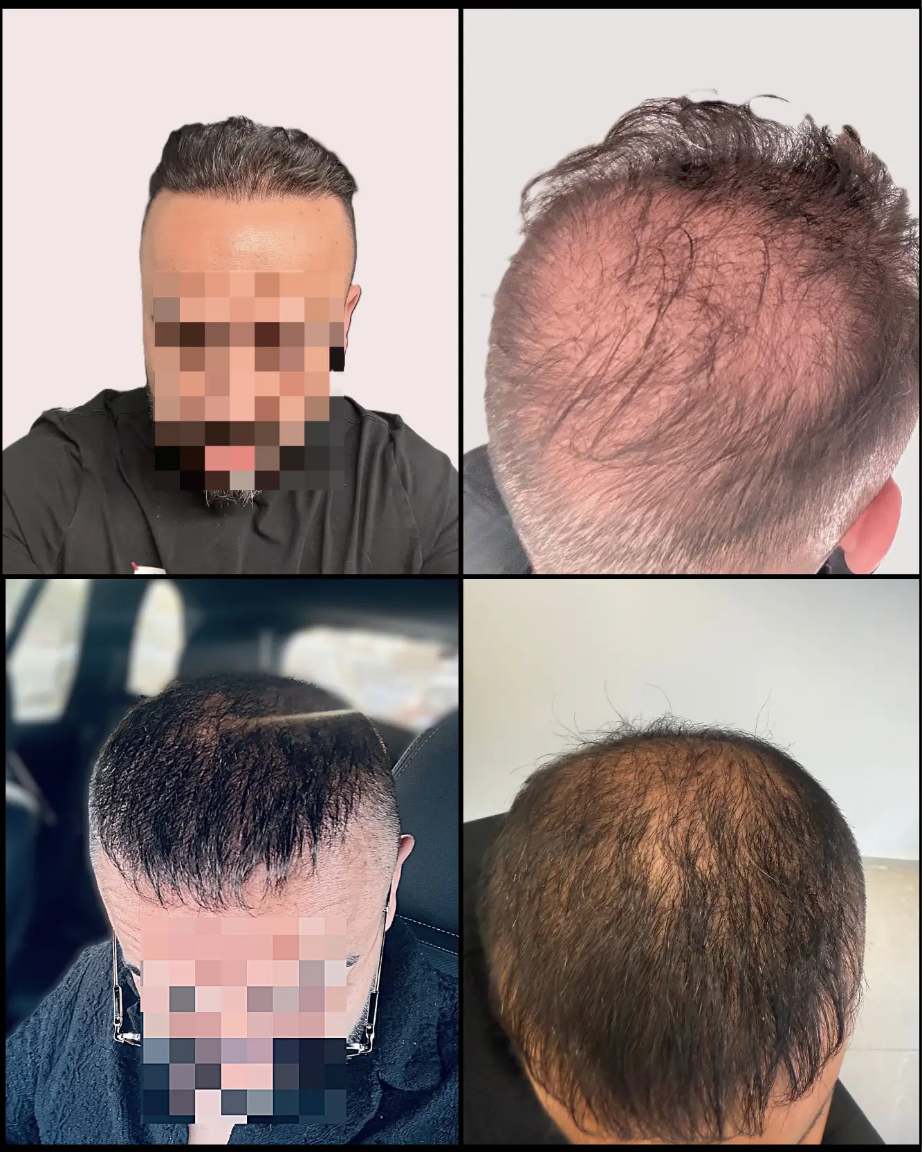 תכנון מחדש לאחר השתלות קודמות