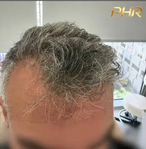 שישה חודשים לאחר השתלת שיער