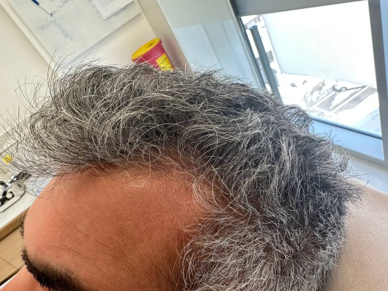 שישה חודשים לאחר השתלת שיער — מבט בזווית