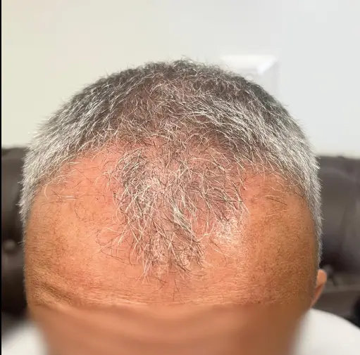 לפני השתלת שיער — קו קדמי וקודקוד