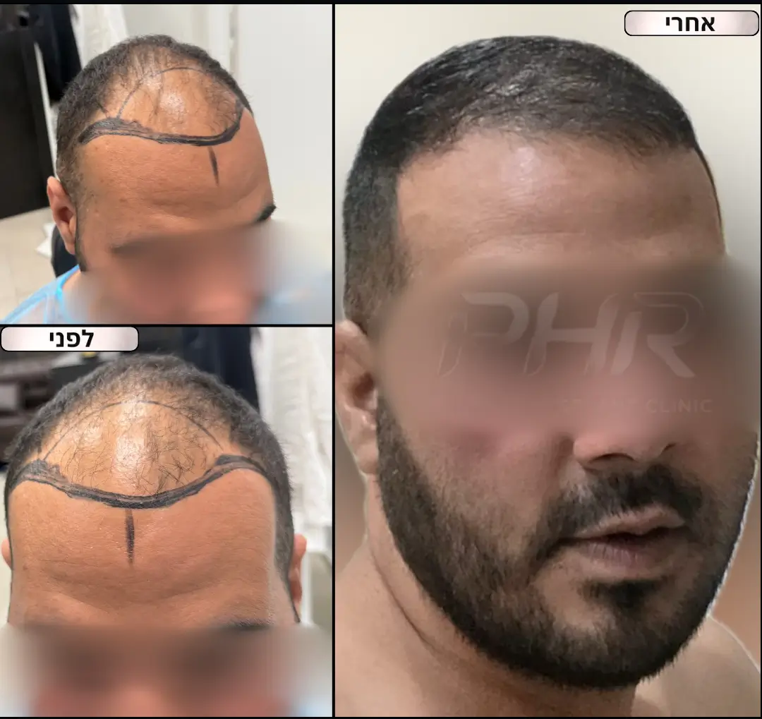 קו שיער חדש שישה חודשים לאחר השתלת שיער